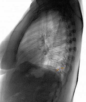 Фото Фиброз