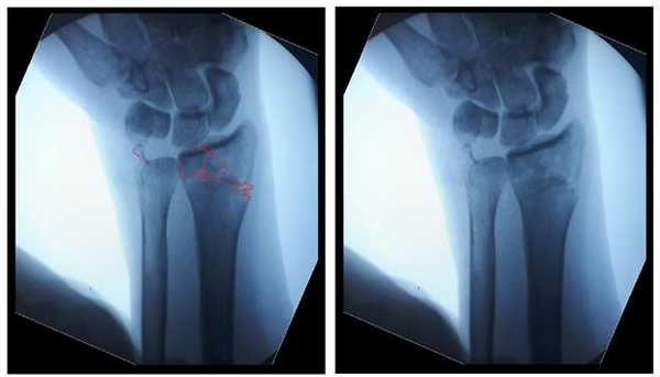 перелом луча в типичном месте репозиция
