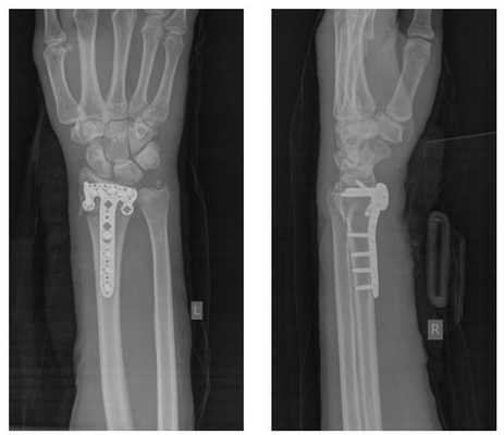 после операции при тяжёлом переломе луча в типичном месте