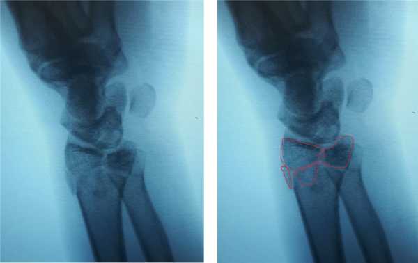 оскольчатый перелом дистального луча 