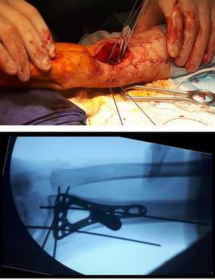 перелом луча в типичном месте операция