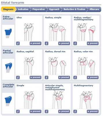 классификация переломов луча в типичном месте АО