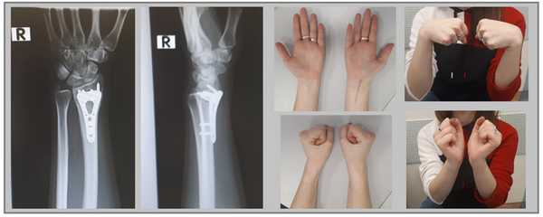 после операции при переломе дистального метафиза лучевой кости