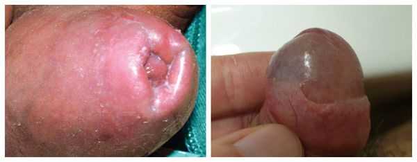 Спайки и сужение крайней плоти в связи с воспалением и отёком