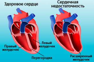Сердечная недостаточность