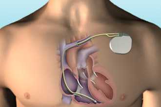 Имплантация электрокардиостимулятора