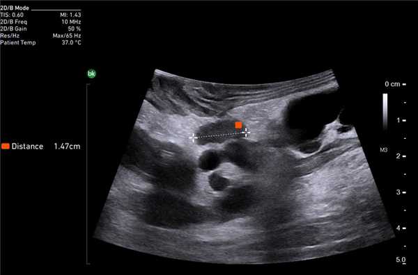 Лимфатические узлы. Сканирование интраоперационным датчиком 8815