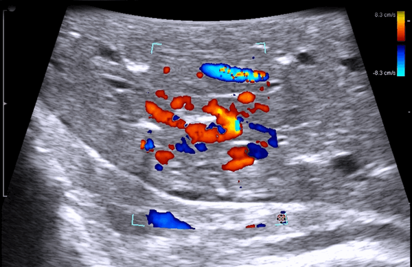 Спавшееся лёгкое
