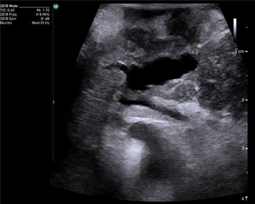 Расширенный панкреатический проток. Сканирование интраоперационным датчиком 8824