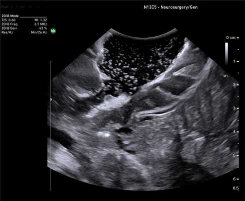 Головной мозг после резекции глиомы