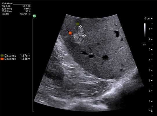 Метастаз печени