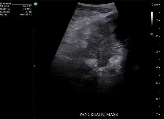 Опухоль поджелудочной железы