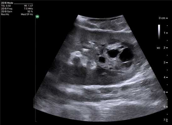 Опухоль почки. Сканирование интраоперационным роботическим датчиком 8826