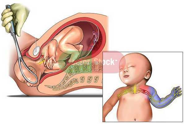 Внутричерепная родовая травма