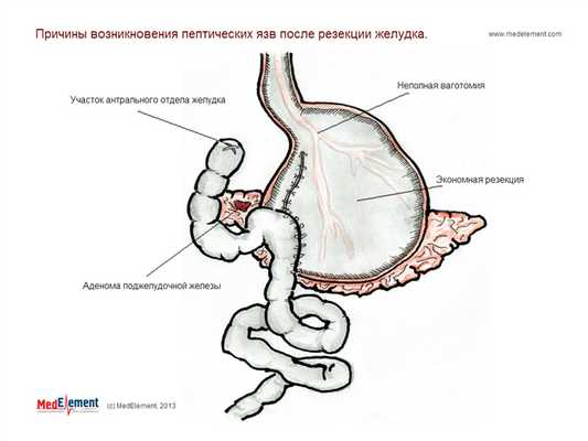 Возникновение пептических язв