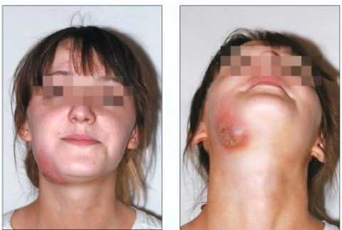 Фото: флегмона поднижнечелюстной области