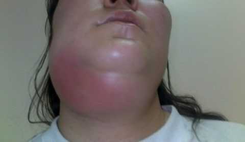 Клиническая картина подчелюстной флегмоны