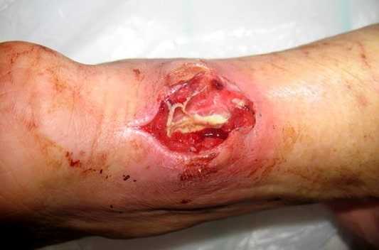 Флегмона голени