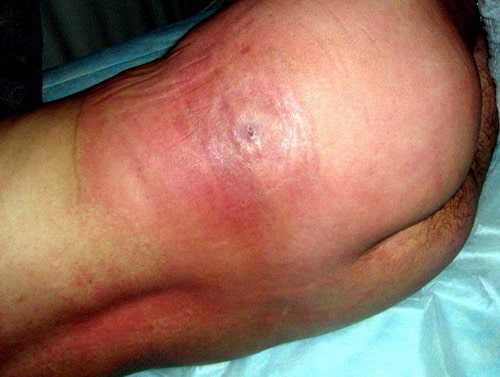 Флегмона мягких тканей на фоне прогрессирующего абсцесса