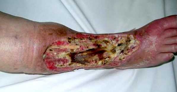 Гнойно-некротическая флегмона голени
