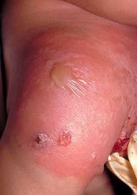 Абсцесс и флегмона