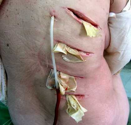 Дренирование флегмоны