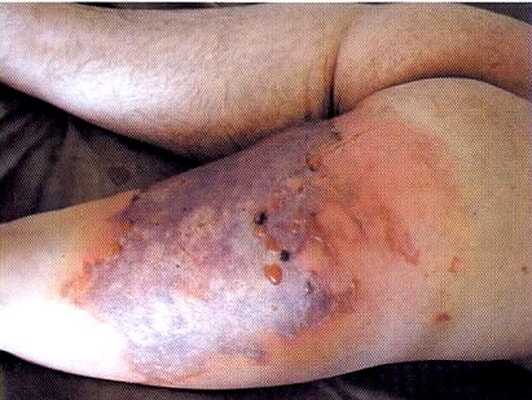 Флегмона бедра