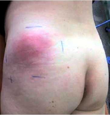 Постинъекционный абсцесс