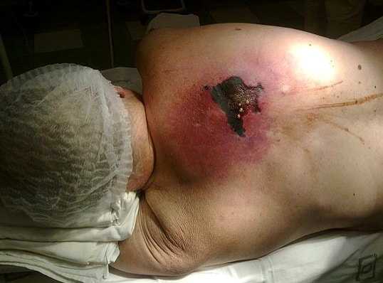 Флегмона спины