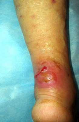 Абсцесс голени