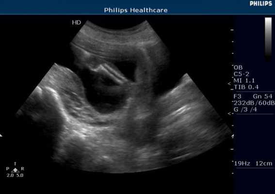 Фокусировка луча при УЗИ-1