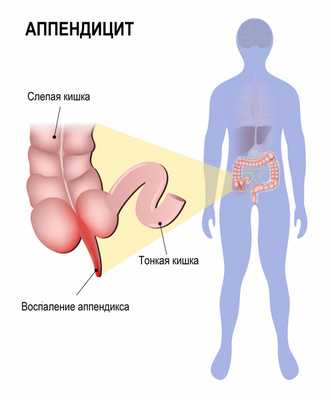 Аппендицит.jpg