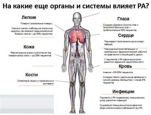 ревматоидный артрит.jpg
