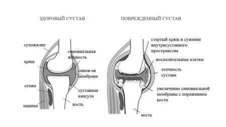 Ревматоидный артрит