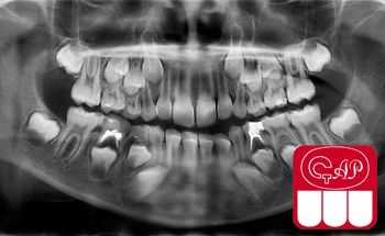 Рентгенологические стадии развития корня зуба и периодонта