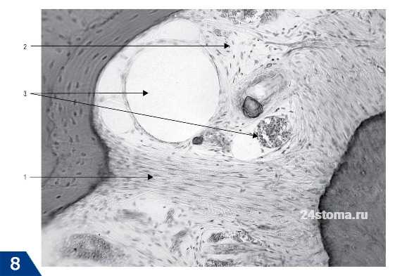  Гистологический препарат. Периодонт: 1 - пучки коллагеновых волокон; 2 - рыхлая соединительная ткань; 3 - сосуды периодонта
