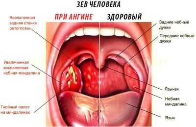 Зев в нормального состоянии и при тонзиллите