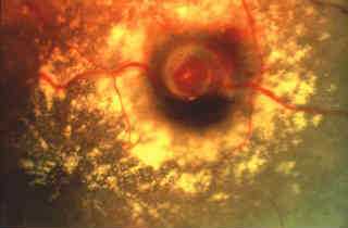 Фотодинамическая терапия глаз в Москве