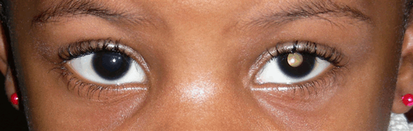 Ретинобластома - рак сетчатки глаза