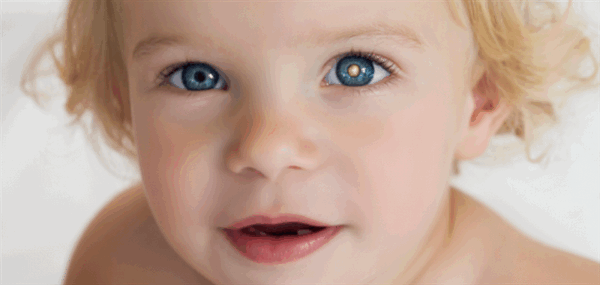 Ретинобластома - рак сетчатки глаза