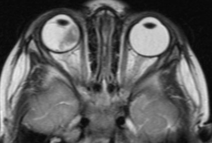 Визуализация ретинобластомы с помощью МРТ. Размеры образования соответствуют клинической группе D