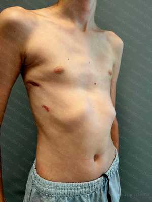 воронкообразная деформация грудной клетки фото после операции