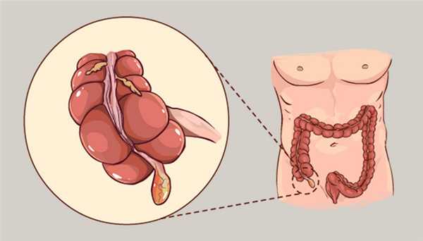 Аппендицит