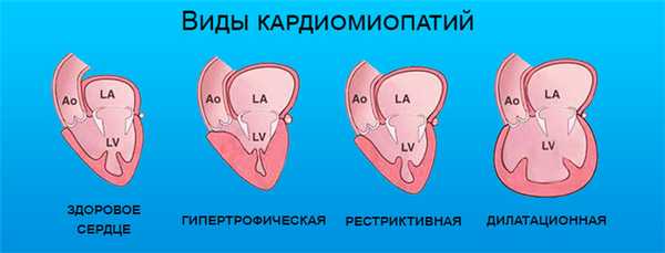 Виды кардиомиопатии