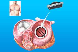 Замена клапана при пороках сердца
