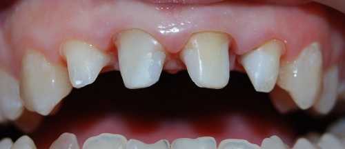 preparirovaniye pod metallokeramiku