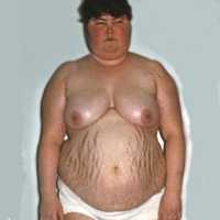 Болезнь Иценко - Кушинга