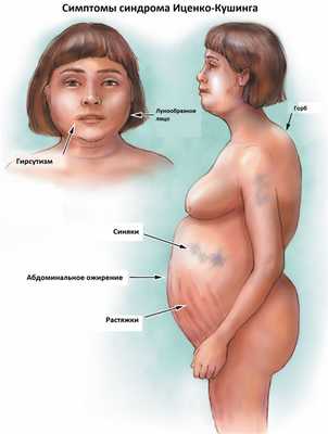 Кушинг_симптомы.jpg