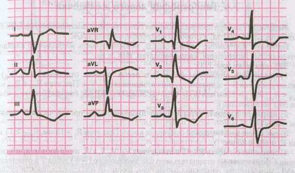 ЭКГ при гипертрофии правого предсердия