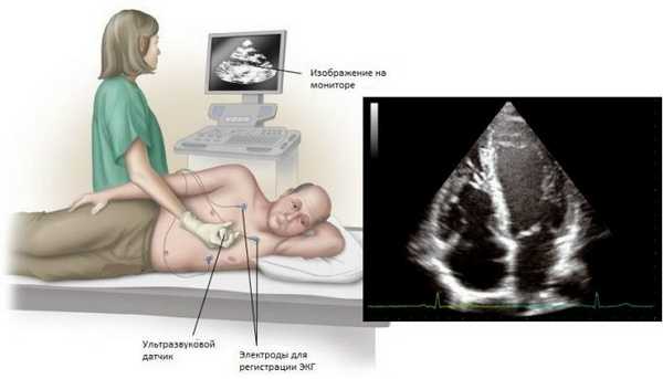 Эхокардиография сердца